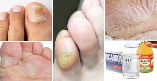 Calluses, calluses and fungi on the feet: how to eliminate them forever and naturally advice | May 12, 2026